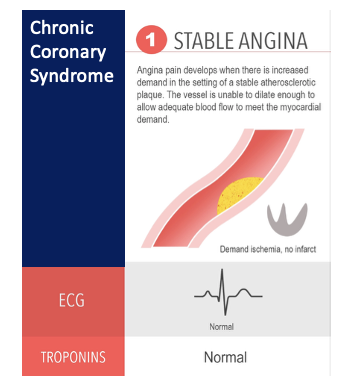 <p style="text-align: left;"></p><ul><li><p style="text-align: left;">crushing sensation in the chest caused by they have narrow blood vessel and reduced blood flow to the heart (ischaemic pain)</p></li><li><p style="text-align: left;">chest pain, tightness, indigestion type pain</p></li><li><p style="text-align: left;">Associated with effort (exercise, cold, excitement) à demand exceeds supply</p></li><li><p style="text-align: left;">Relieved by rest or medications</p></li><li><p style="text-align: left;">Short lived</p></li><li><p style="text-align: left;">predictable and reproducible&nbsp;</p></li></ul><p></p>
