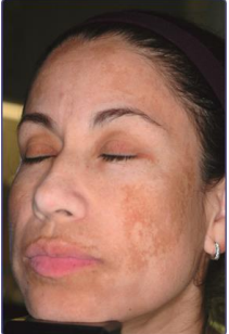 <p><strong>Diagnosing Melasma</strong></p><p>-Usually based on ________ presentation</p><p>-_______ lamp may assist in identifying the location of pigment</p><p>-Dermascopy could aid in diagnoses and identify levels of pigment deposition</p><p>-__________ testing causes increased melanin deposition in all layers of the epidermis </p>