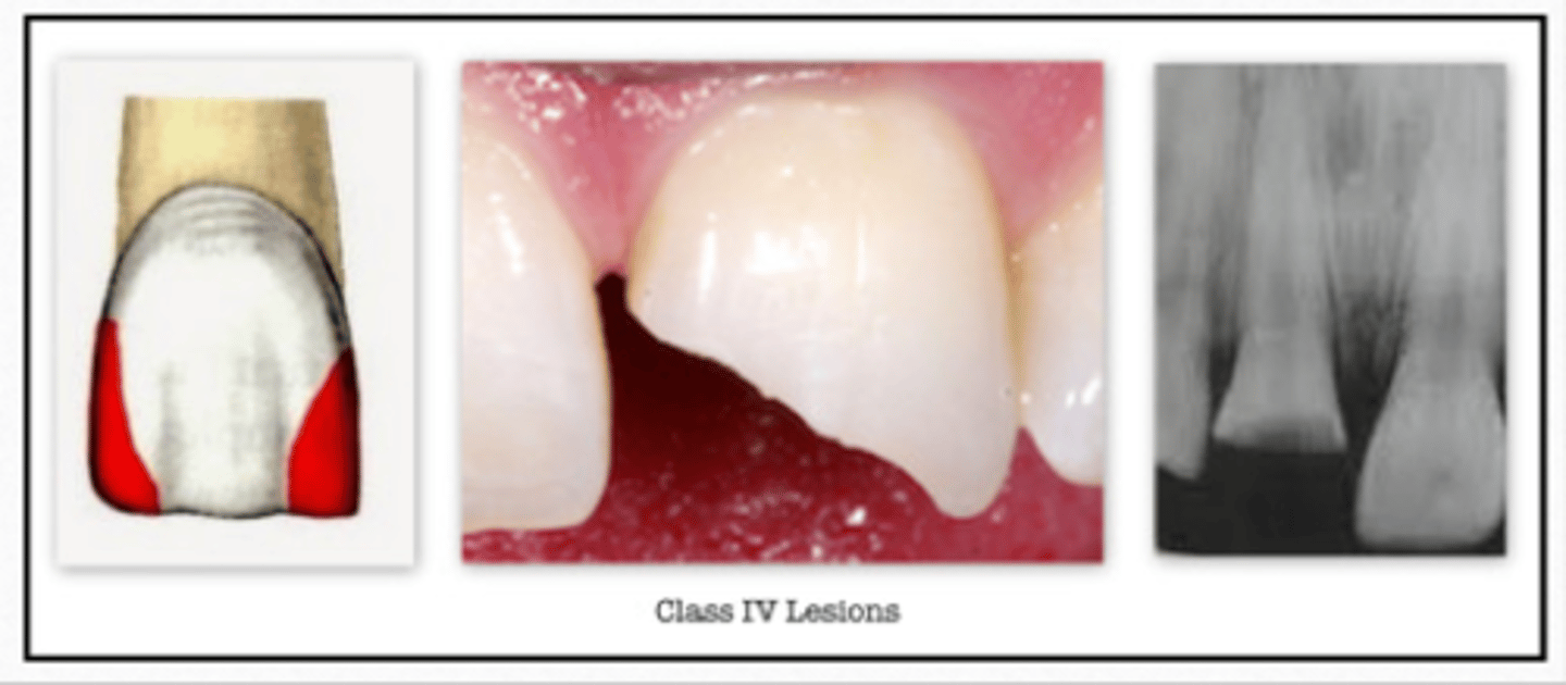 <p>GV Black Classification of Caries:</p><p>- Interproximal surface of anterior teeth</p><p>- DOES includes the incisal edge</p>