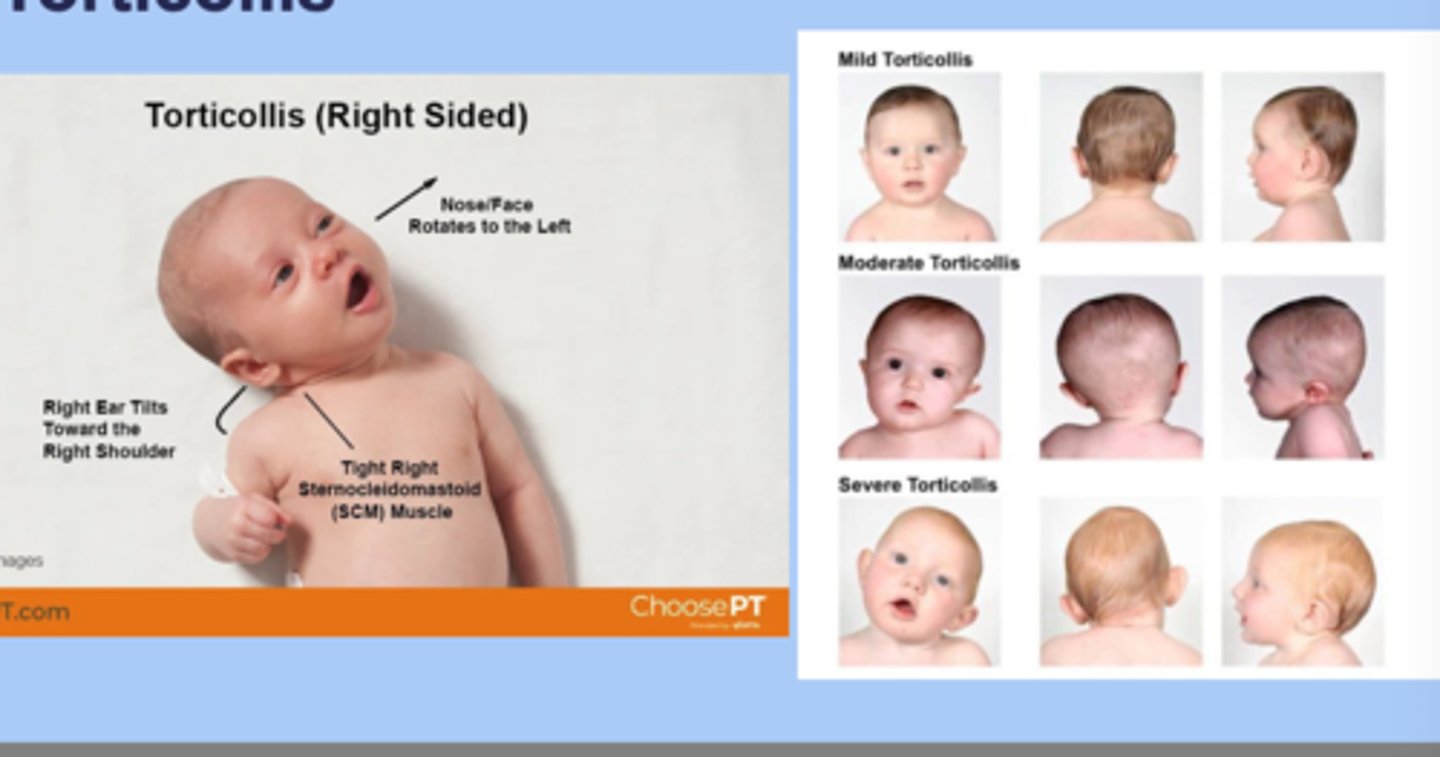 <p>-lateral twisting of the neck that causes the head to tilt to one side with the chin turned to the opposite side </p><p>-congenital: most common arises from muscular fibrosis of the SCM </p><p>-acquired: secondary to other </p><p>-sx: chin OPPOSITE side of affect muscle, head TOWARD affected muscle </p><p>-dx: 20% associated with DDH, evaluate for plagiocephaly </p><p>-tx: passive stretching </p>