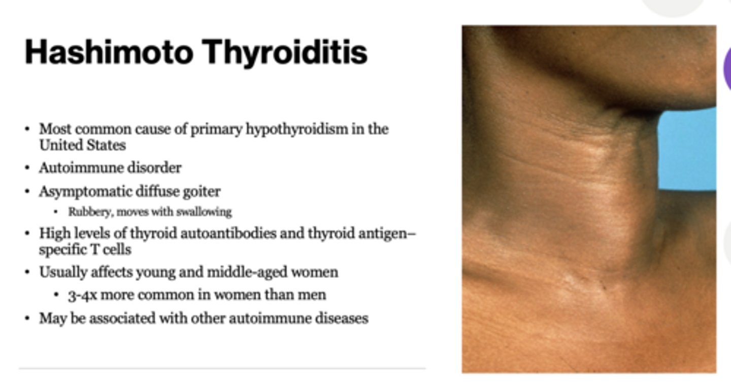 <p>Hashimoto Thyroiditis</p>