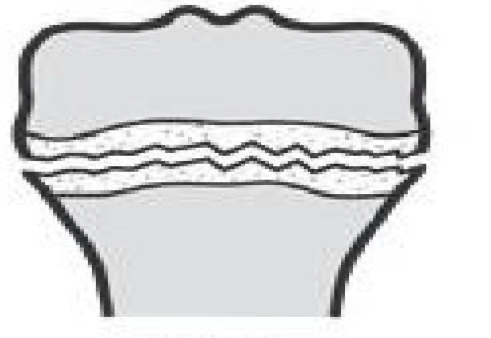 <p>what type of fracture is this?</p>