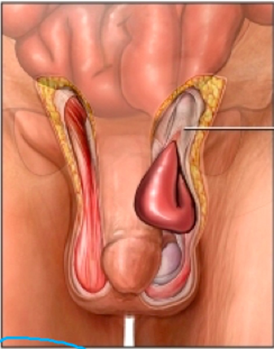 <p>Protrusion of tissue through abdominal wall into inguinal canal.</p>