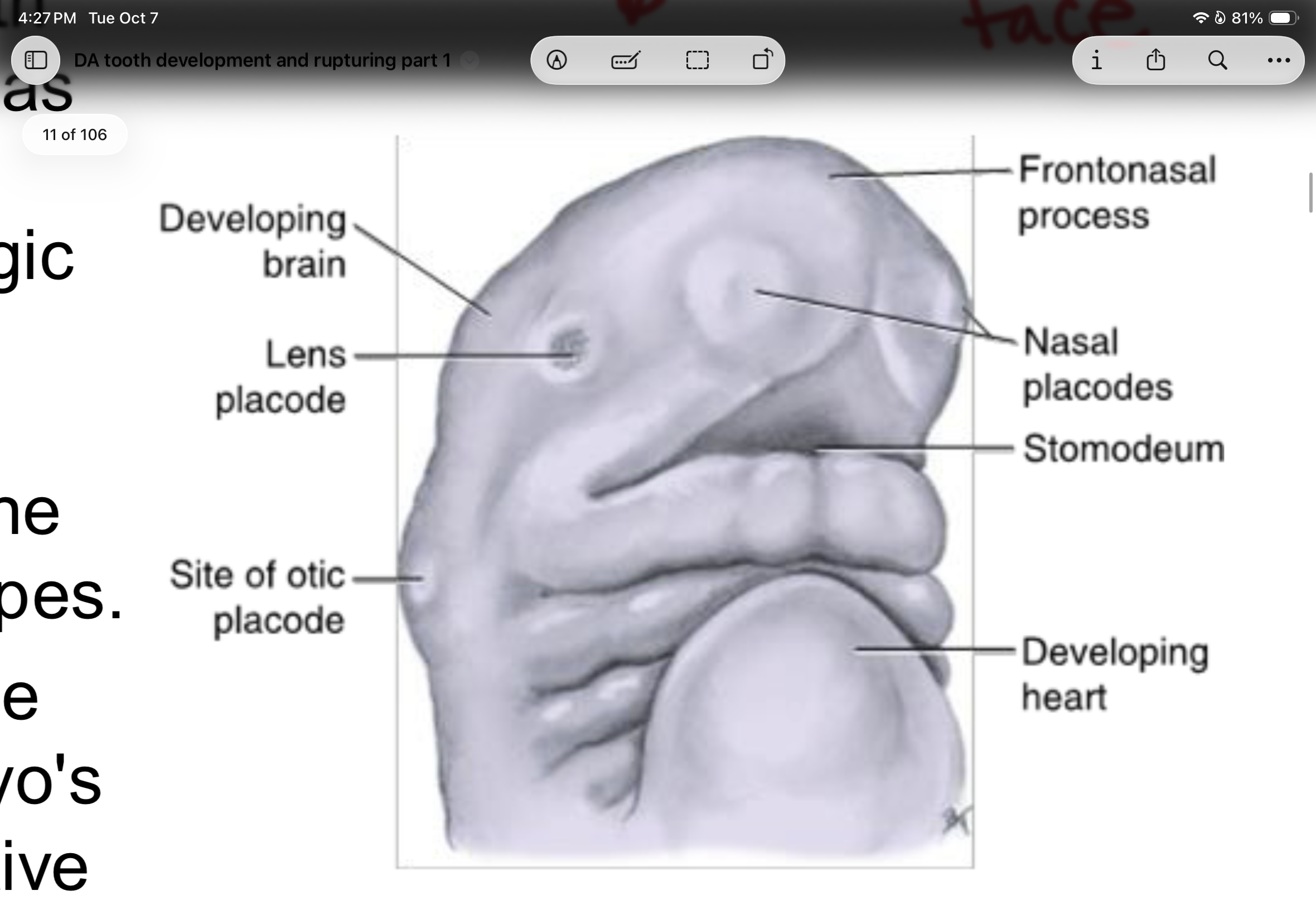<p>Embryo at the _______ week of prenatal development showing the developing brain, the forming face from the growth of the frontonasal process with its stomodeum and placodes, and the developing heart.</p>
