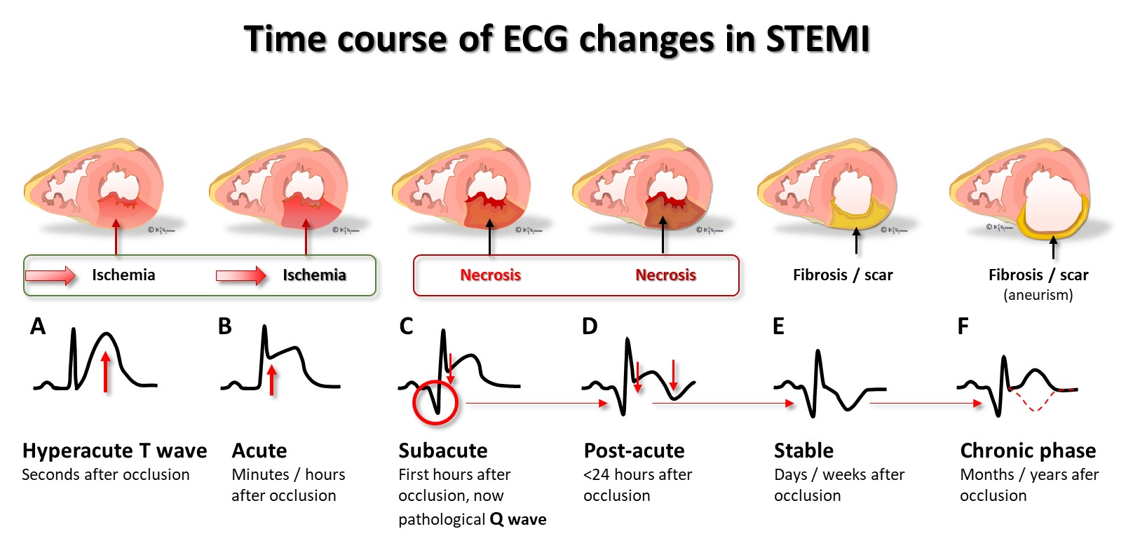 <ul><li><p><strong>Scarring</strong></p></li></ul><ul><li><p>ersistent, broad, and deep Q-waves indicate the formation of scar tissue where myocardial necrosis occurred. T-wave inversions may remain, and R-waves may not fully recover, showing incomplete healing.</p></li></ul>