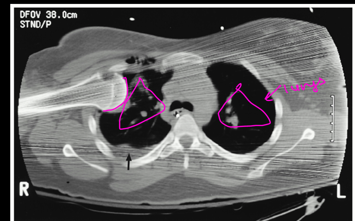 <p>What is the clinical diagnosis of this dislocation?</p>