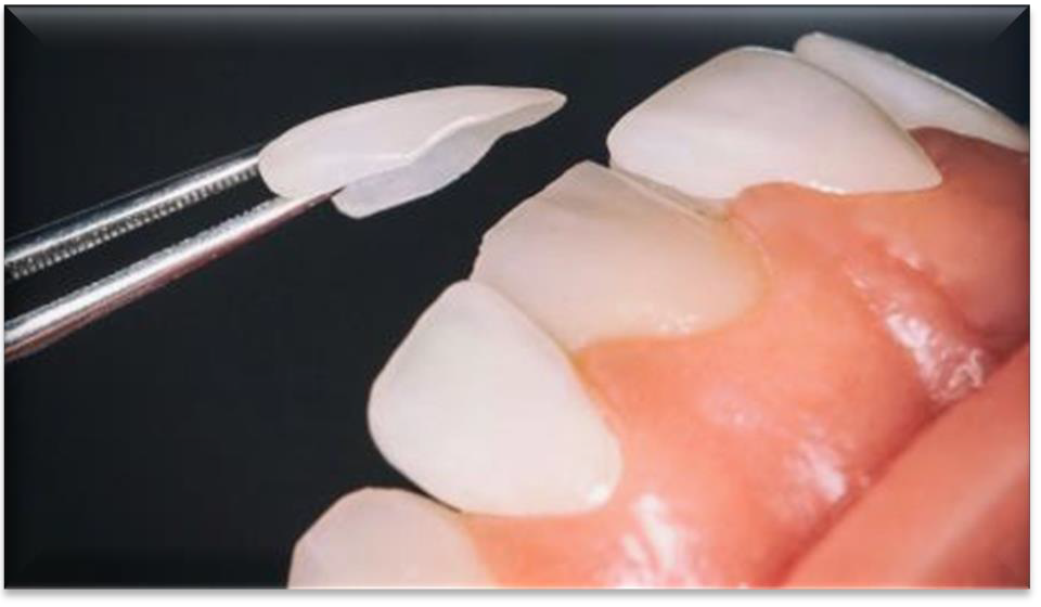 <p>Very thin shells (made of composite resin or porcelain) that attach to the front part of the teeth.</p>