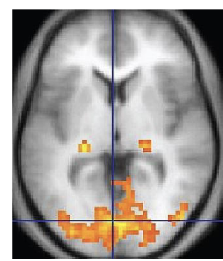 <p>Functional Magnetic Resonance Imaging (fMRI) </p>