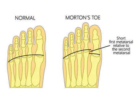 2nd toe is longer than 1st toe 