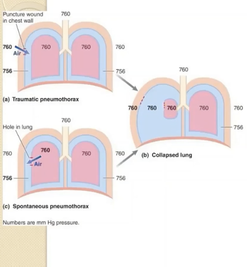 <p>the intrapleural and intra-alveolar pressure are now equal with atmospheric pressure </p><p></p><p>no longer any pressure holding the lung to the thoracic cage (pleural cavity no longer has that negative pressure)</p>