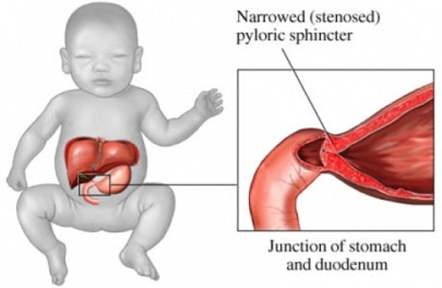 <p>Hypertrophy of pylorus muscle resulting in gastric outlet syndrome; projectile non-bilious vomiting followed by a desire to feed (nothing is getting past), dehydration (sunken fontanelles), palpable olive-like mass in the epigastric/RUQ area</p>
