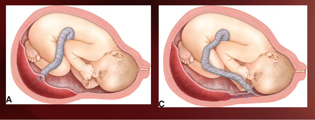 <p>When umbilical cord branches out into separate vessels before actually entering placenta</p><p>a= normal; c= velamentous</p>