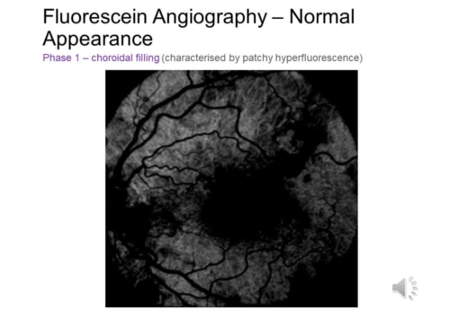 <p>CHOROIDAL FILLING (characterised by patchy hyperfluorescence)</p>