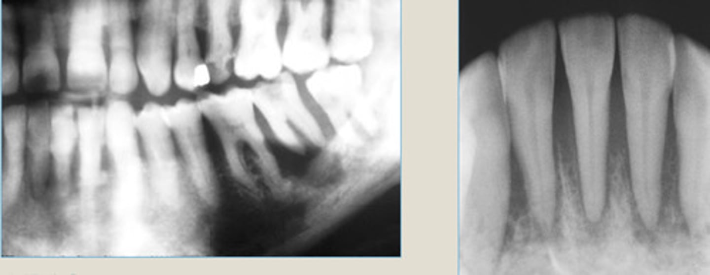<p>LEFT: destruction of alveolar bone surrounding roots of MN 2nd M</p><p>RIGHT: carcinoma metastatic to jaws, widening of PDL</p>