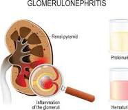 <p><strong>A patient has just been diagnosed with acute glomerulonephritis. Which question should the nurse ask this client in attempting to establish a cause?</strong></p><p>A) “Do you have a history of heart failure?”</p><p>B) “Have you recently had kidney stones?”</p><p>C) “Have you ever been diagnosed with diabetes?”</p><p>D) “Have you had any type of infection within the last 2</p><p>weeks?” </p>