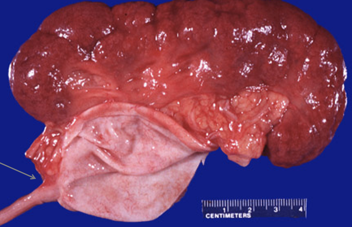 <p>What pathology is shown here?</p>