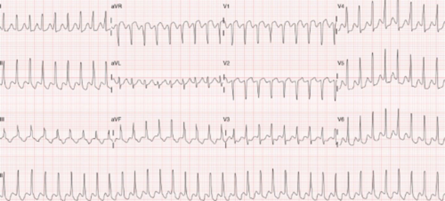 <p>- Regular, narrow complex tachycardia</p><p>Tx: Valsalva Maneuvers, Adenosine</p>