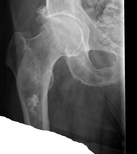 <p>What does this refer to</p><ul><li><p>Radiograph shows <strong>popcorn leisions</strong>!!!</p></li></ul><p></p>