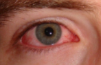 <p>what is keratoconjunctivitis?</p>