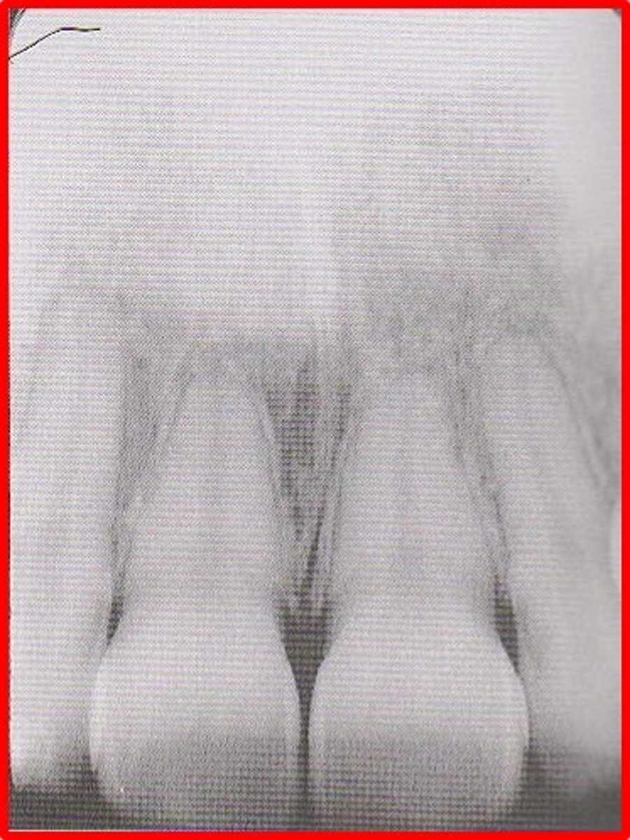<p>vertical angulation too high</p><p>teeth appear shorter than actual size</p>