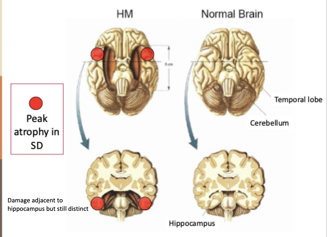 <p>damage adjacent to hippocampus but still distinct</p>
