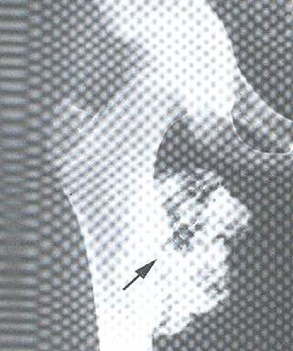 <p>A benign bony projection covered with cartilage.</p>