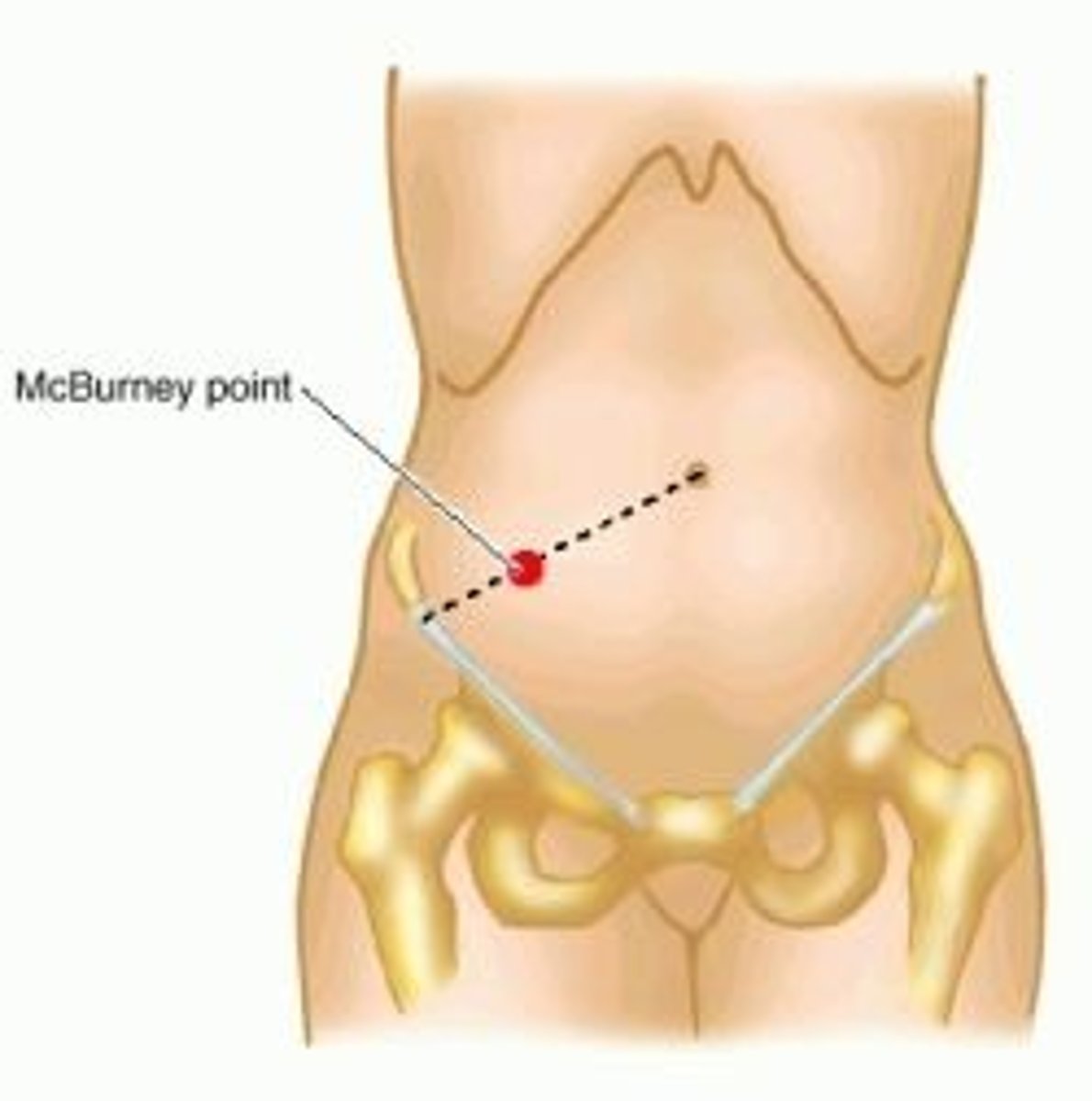 <p>inflammation of the appendix</p>