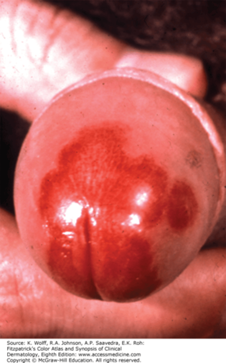 <p>Uncommon condition that causes red patches on the penis </p><p>- Cause is unknown </p><p>- Condition may resemble precancerous lesion </p>