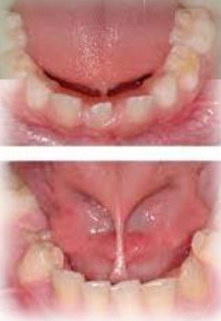 <p>Short and thick lingual frenum, or attachment of fremum to tip of tongue - may cause a slight cleft at tip</p><p class="has-focus">Present at birth</p><p class="has-focus">No gender bias</p><p class="has-focus"><strong>Found on:</strong></p><p class="has-focus">Ventral tongue</p><p class="has-focus">Floor of mouth</p>