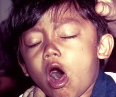 <p>common cold manifestations (catarrhal stage)</p><p style="text-align: left;">severe coughing starts in weeks 1-2 (paroxysmal stage)</p><p style="text-align: left;">- coughing fits, violent and rapid coughs, <strong>loud</strong> <strong>"whooping" cough</strong></p>