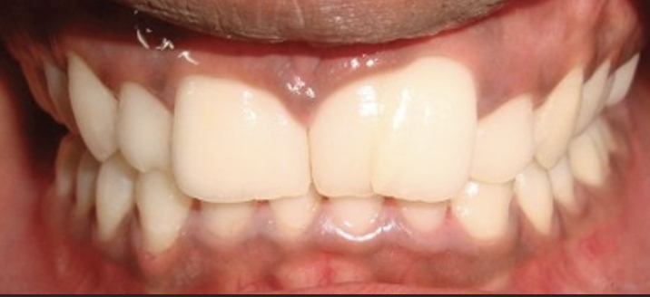 <p>Hierbij zijn er meerdere wortels, maar wel 1 kroon. Dit is dus het tegenovergestelde van geminatie.</p>