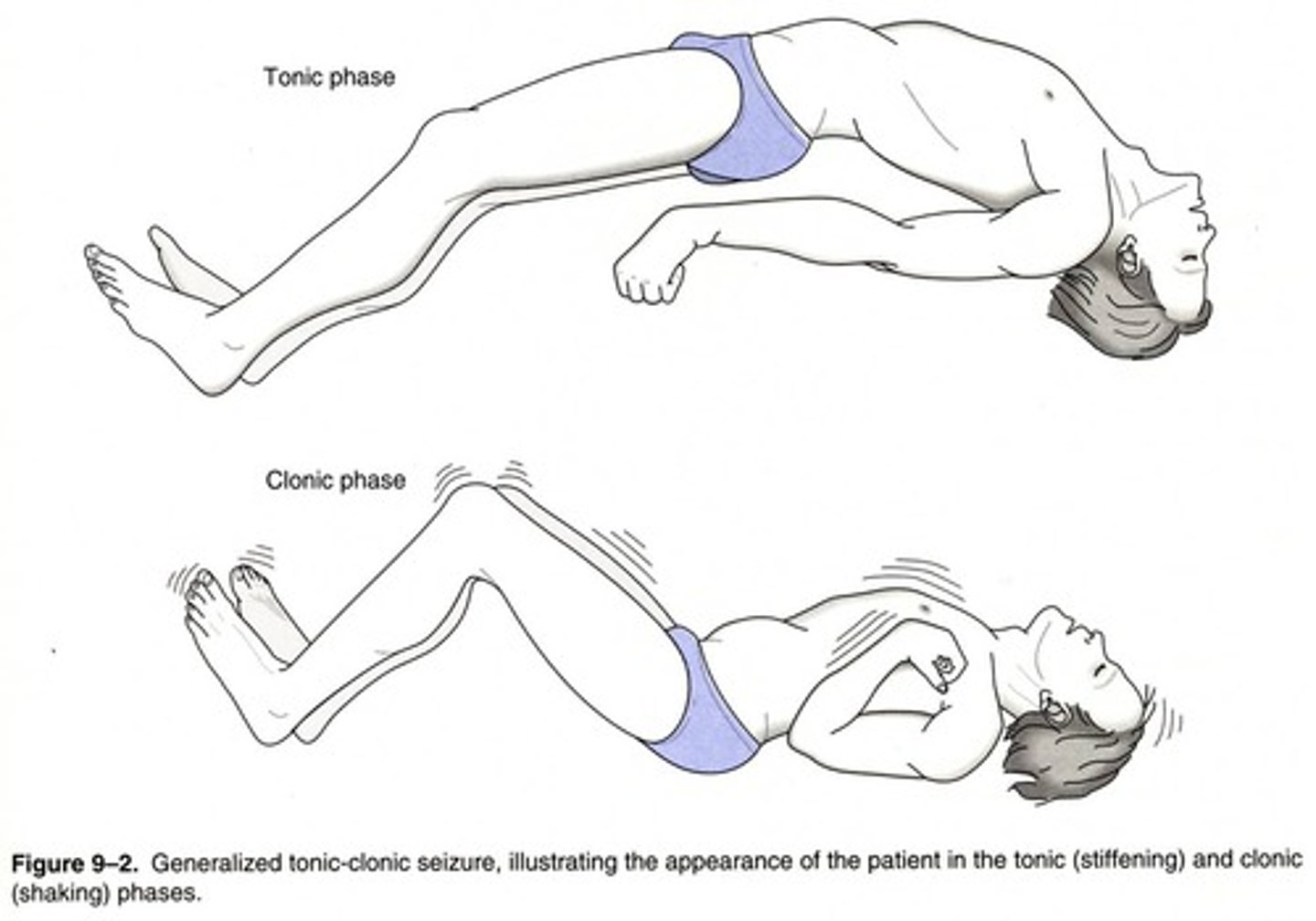 <p>a very sudden attack of an illness in which someone becomes unconscious or develops violent movements: Cơn co giật</p><p>Synonyms: Convulsion, epileptic fit</p><p>Example: The child had a seizure and was rushed to the hospital</p>