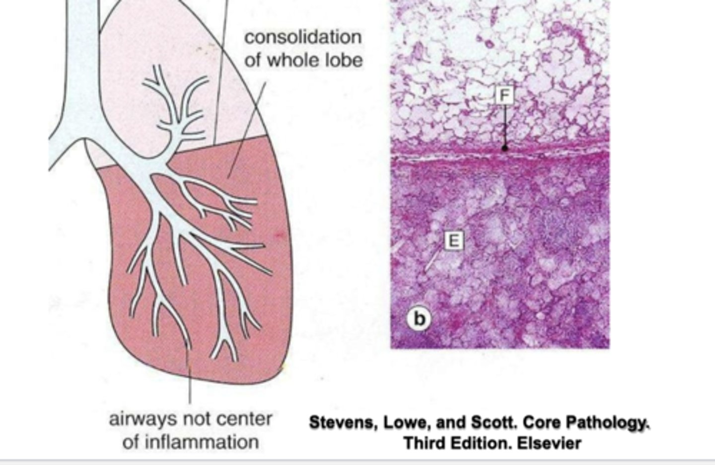 <p>-consolidation of the entire lobe below the pulmonary fissure</p><p>-airways not center of inflammation</p>