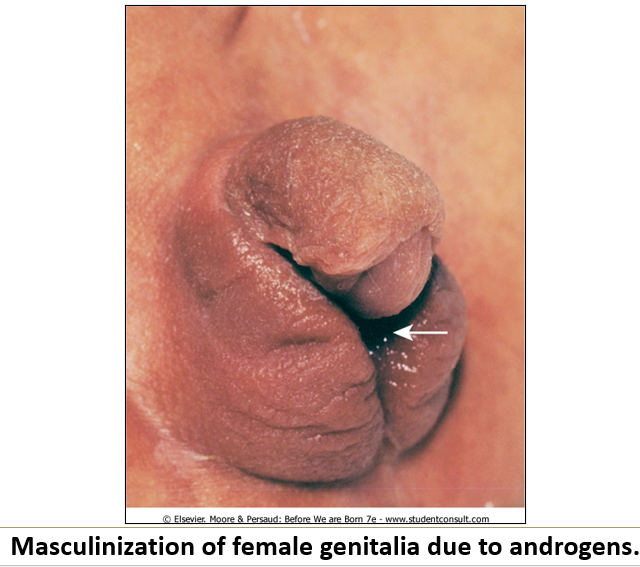 <ol><li><p class=""><strong>Androgens</strong> cause <strong>masculinization</strong> of <strong>female fetuses</strong></p></li><li><p class=""><strong>Progesterone</strong> (in birth control) is linked to <strong>VACTERL syndrome</strong></p></li><li><p class=""><strong>Diethylstilbestrol</strong> leads to <strong>genital tract anomalies</strong> and <strong>vaginal adenocarcinoma</strong> in offspring</p></li></ol><p></p>