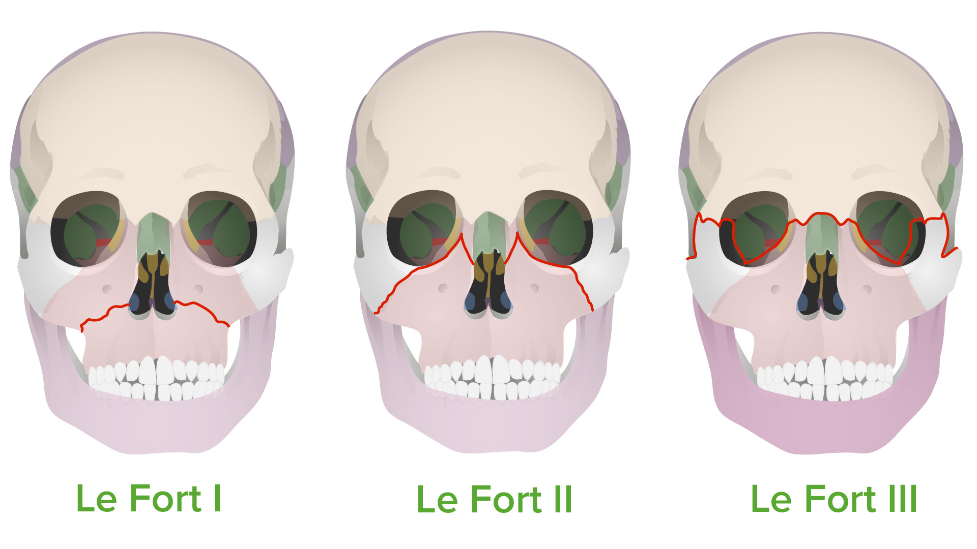 <p>LeFort 1: between alveolar and nasofrontal</p><p>LeFort 2: between nasofrontal and malar</p><p>LeFort 3: below anterior temporal and midfrontal</p><ul><li><p>most frequently occurs in high-speed car accidents or falls, or striking the face directly with a rigid object</p></li></ul>
