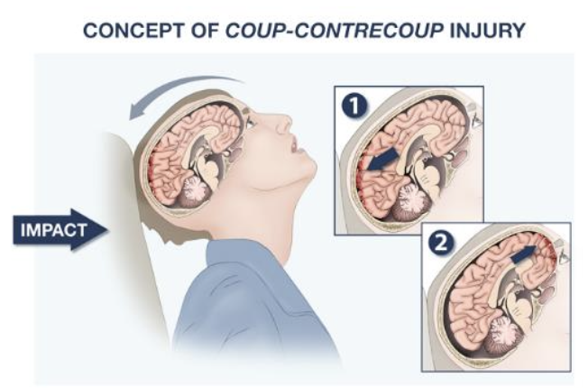 <p>contrecoup</p>