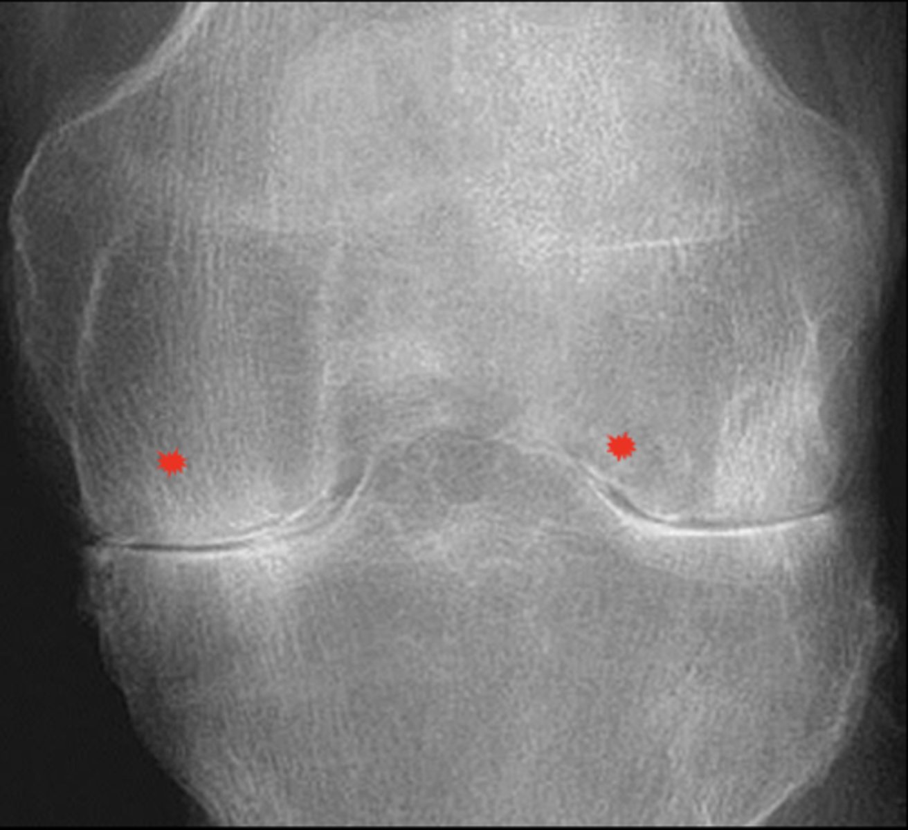 <p>Inflammatory _____ loss of joint space</p>
