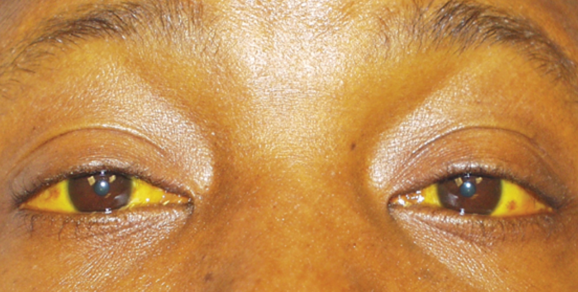 What is this?

A. Shingles

B. Small pox

C. Herpes

D. Jaundice