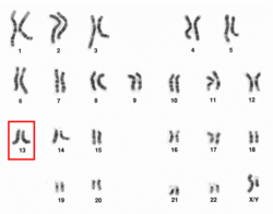 <p>related to chromosome 13- a tumor suppressing gene</p><ul><li><p>since retinoblastomas are caused by a tumor suppressing gene, it leaves patients susceptible to other cancers later in life</p></li></ul><p></p>