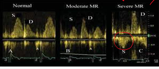 <p>look for reversal of S wave </p>