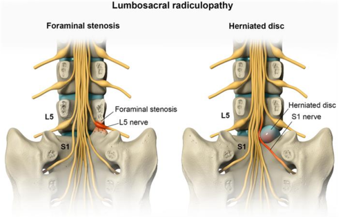 -Compression from degenerative joint disease and herniated disks
