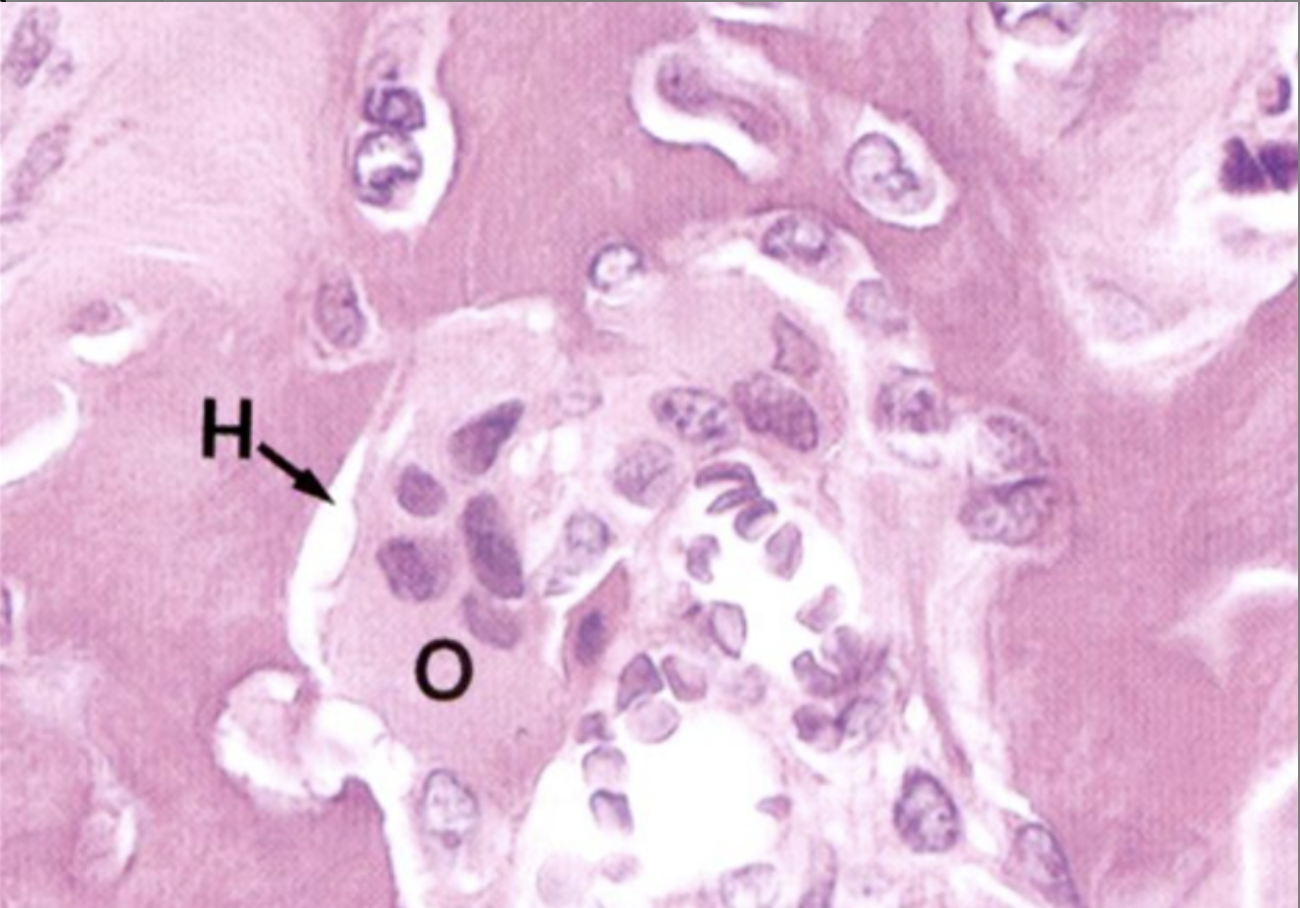 <p>a depression resorbed from bone surface, into which acid and proteolytic enzymes are released from osteoclasts</p>