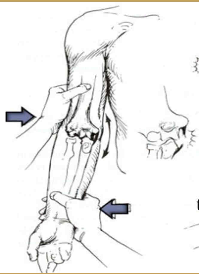 <p><strong><span>Purpose: </span></strong><span>To assess the stability of the medial collateral ligaments or MCL sprain</span></p><p><strong><span>Steps:</span></strong></p><p><span>1.The client is seated, the elbow positioned in slight flexion, and the forearm supinated.</span></p><p><span>2.The therapist places one hand on the lateral aspect of the elbow joint and the other hand medially on the mid portion of distal forearm. This allows for greater ease in the application of a valgus force by not allowing any shoulder rotation.</span></p><p><span>3.The therapist applies a valgus force to the elbow by pushing the Humero-ulnar joint toward the body.</span></p><p><strong><span>&nbsp;Result:</span></strong><span> The test is positive if the client either feels pain or the therapist feels or sees gapping along the medial aspect of the elbow.</span></p>