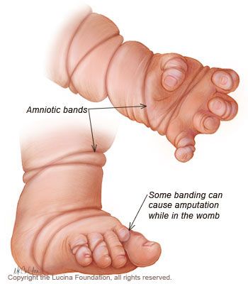<p>What are<strong> amniotic bands</strong> and how do they form?</p>