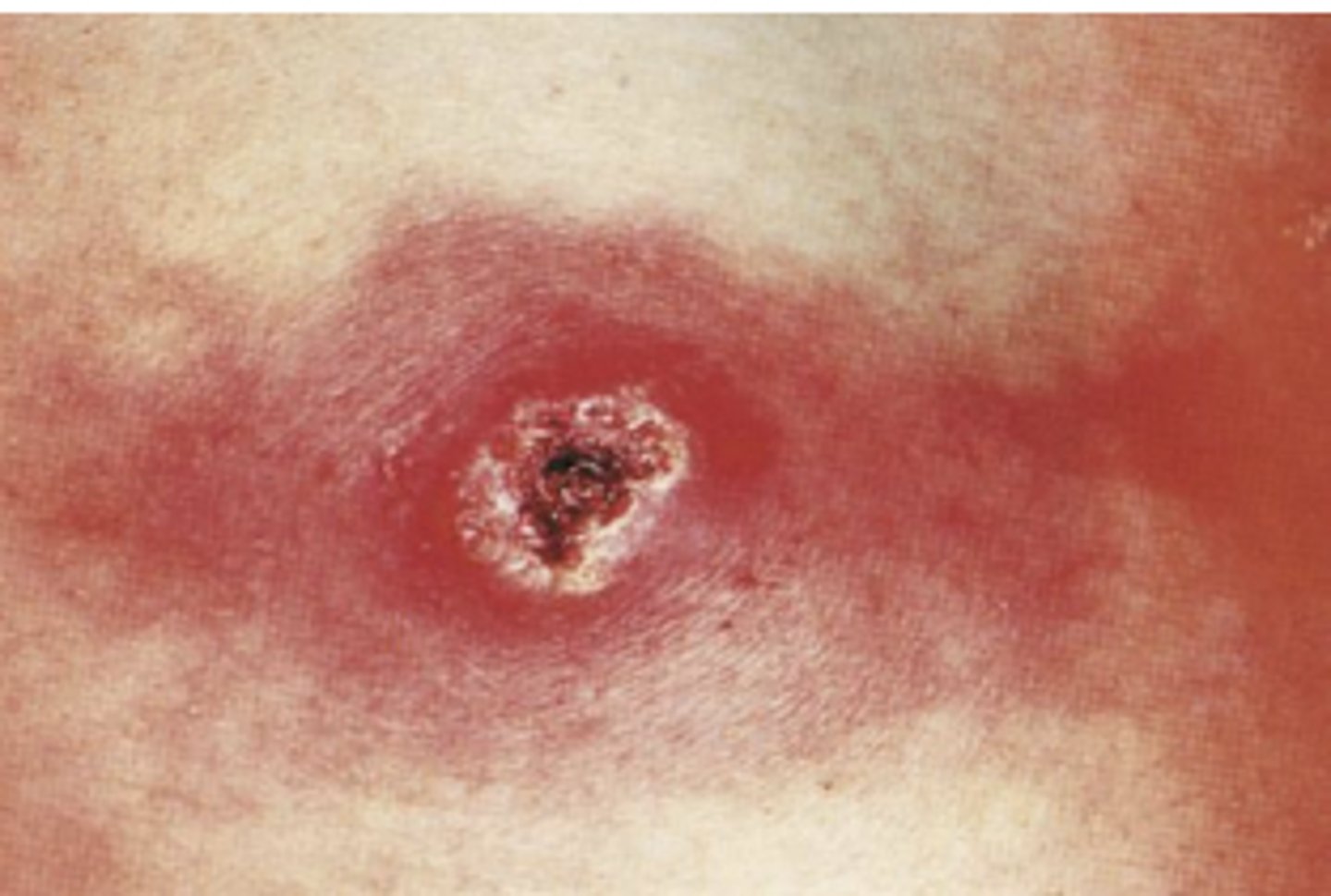 <p>Inoculation: virulent pathogen, local effect which can lead to travel in bloodstream (sepsis & fever)</p>