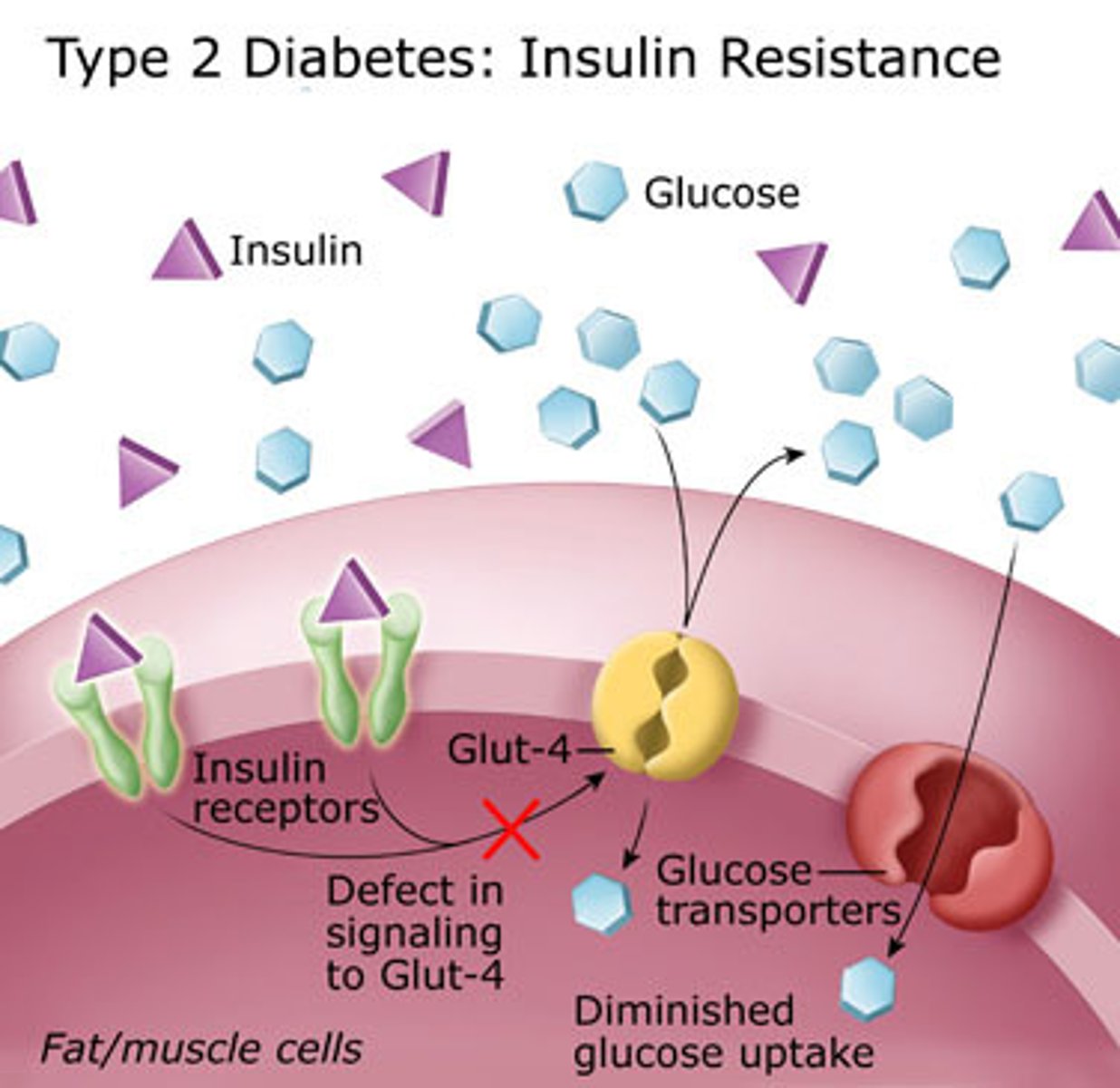 <p>when excess blood sugar levels mean cells become less responsive to insulin<br>- stored as fat</p>