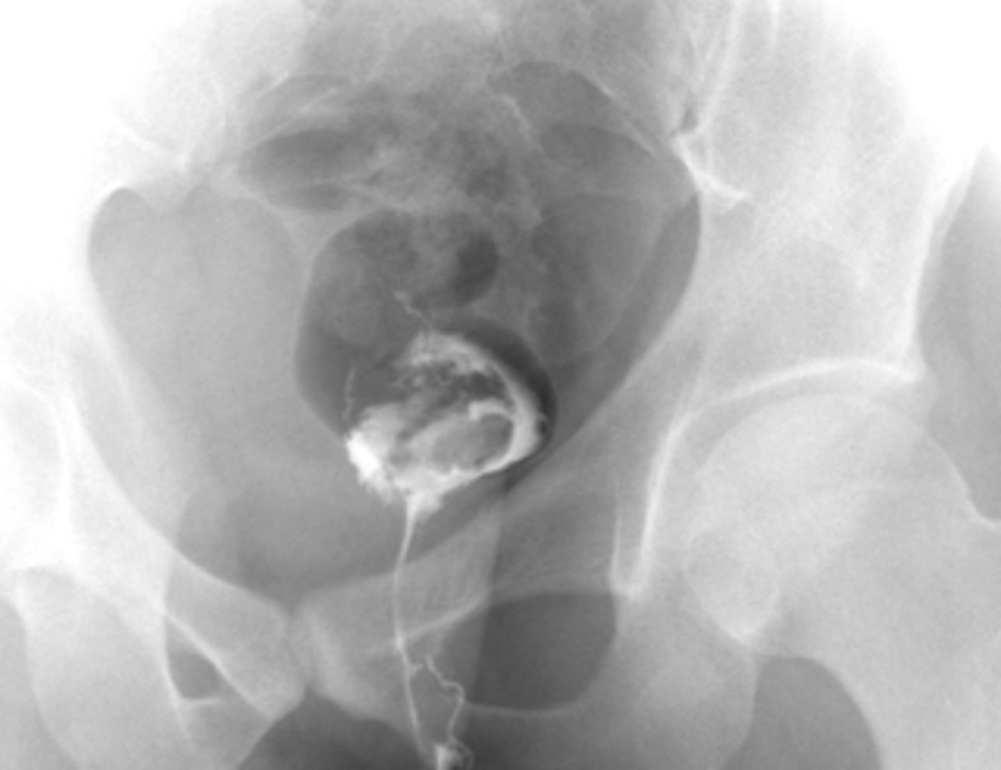 <p>A pt presents with complaints of <strong>constant drainage from the perianal region</strong>. Upon PE you see an external opening with a dimple. The radiographic imaging is attached --- what is the likely dx?</p>