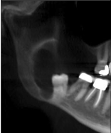 <p>Lateral dentigerous cyst</p>