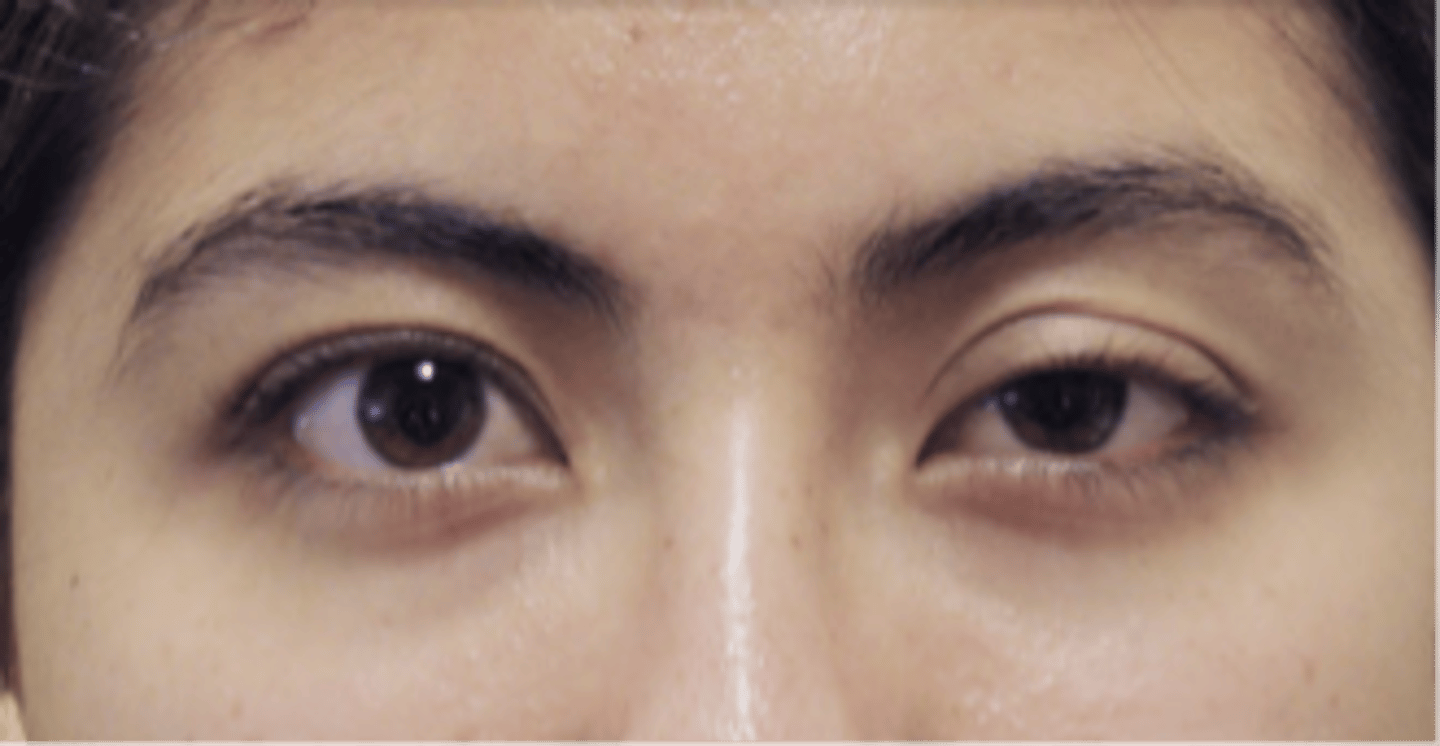 <p>name the eyelid abnormality</p>