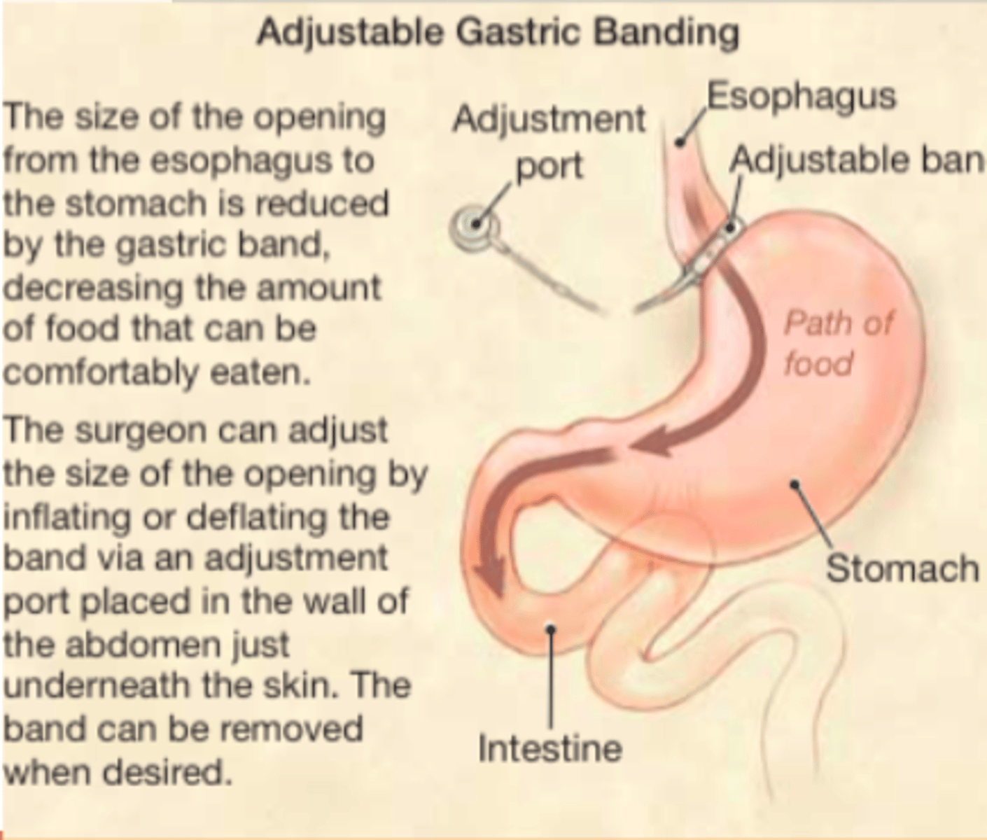 <p>- silicone band placed around upper stomach to limit food intake</p><p>- band is adjustable; can control food intake</p><p>20-25% weight loss from baseline</p>